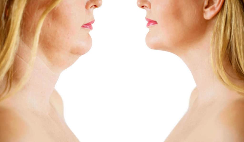 Double Chin treatment Upton Park before and after results