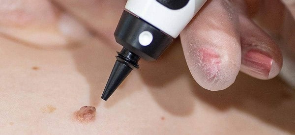 After Skin Tag Removal Upton Park