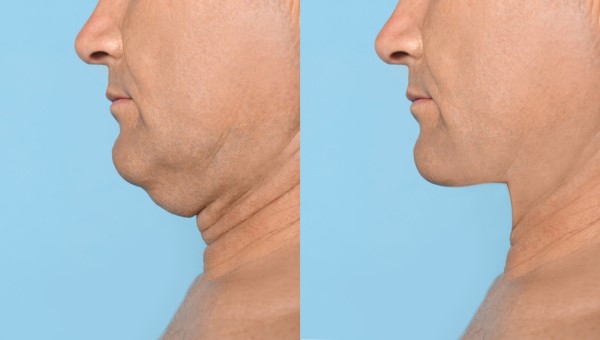 Which Non-Surgical Treatments Work Best for Jowls and Loose Skin Upton Park?