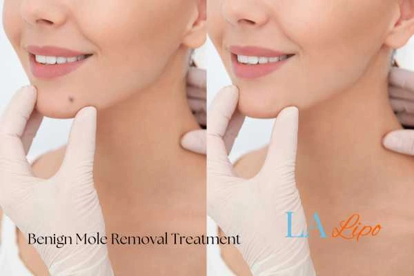 Before-and-after results following benign mole-removal treatment Upton Park