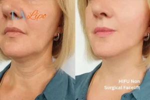 hi-fu for wrinkles Upton Park before and after results
