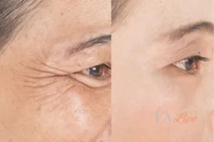 Before and after results of woman - HI-fu wrinkles reduction treatment Upton Park