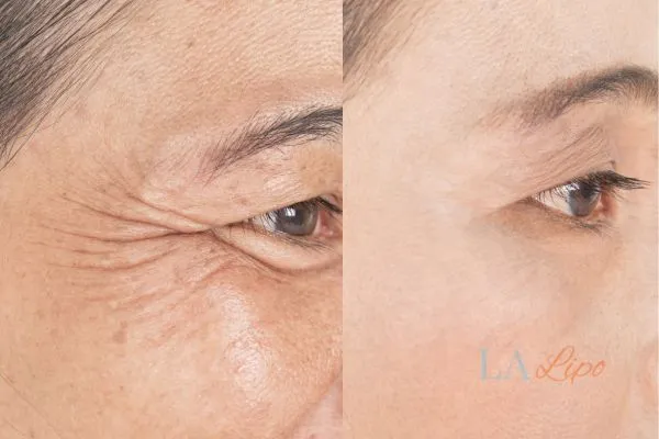 Before and after results of woman - HI-fu wrinkles reduction treatment Upton Park
