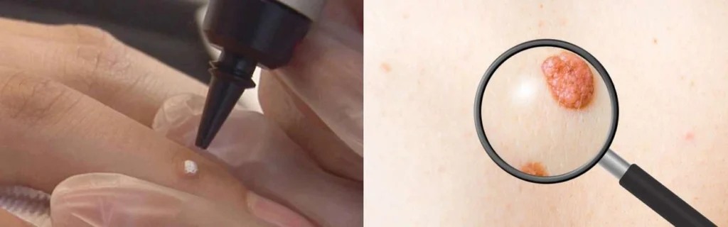 CryoPen practitioner Upton Park assessing a benign mole before treatment