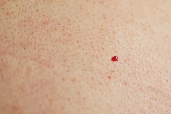 close up of a cherry angioma Upton Park