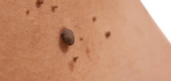 image of a skin tag Upton Park