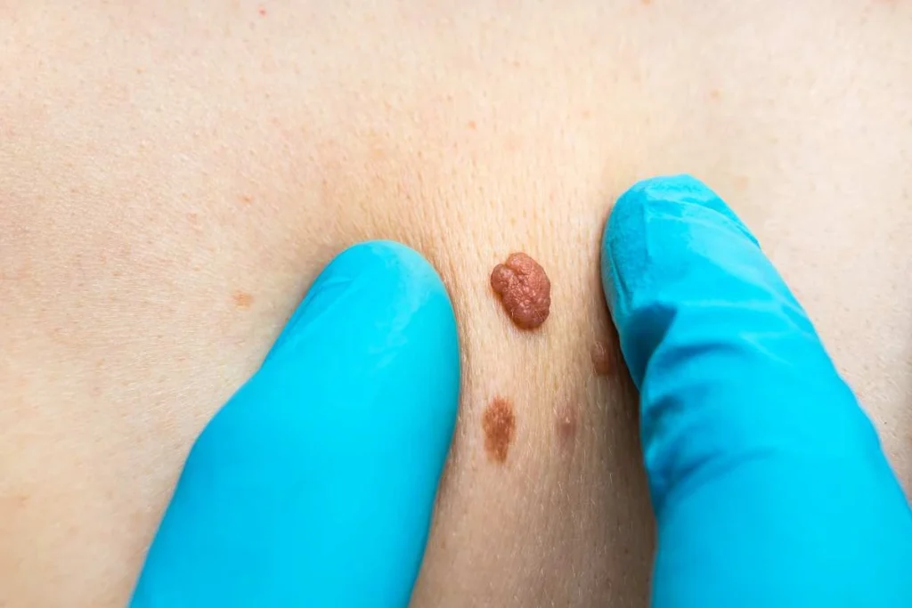 Consultant examining a skin tag Upton Park