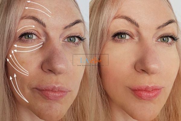 Morpheus 8 results Upton Park face lift.