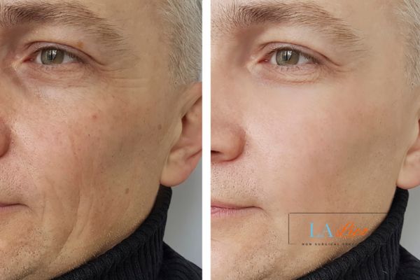 See the amazing results of Morpheus8 Treatment Upton Park!