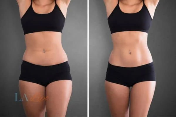 before and after results of non-surgical treatment to help a woman's body image and mental health Upton Park