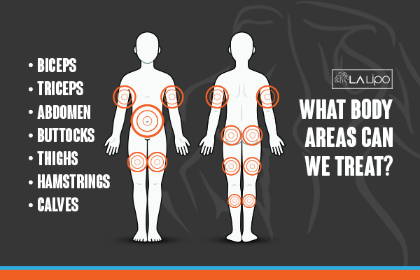Diagram to show areas you can have LA-EMS Body Sculpting Treatment Upton Park
