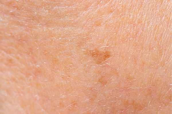 close up picture of age spots Upton Park