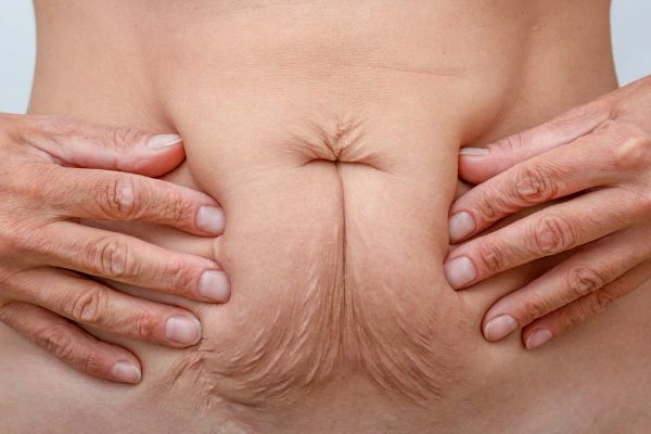 Should I Combine Diastasis Recti Treatment with Body Contouring for Better Results Upton Park?